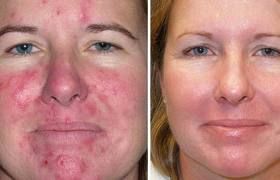 How do acne pass